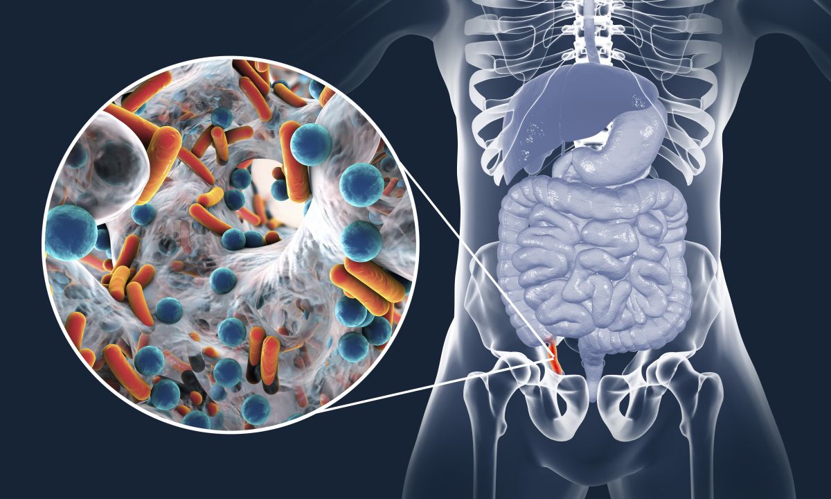 Acute Appendicitis And Close up View Of Bacteria In Appendix, Th