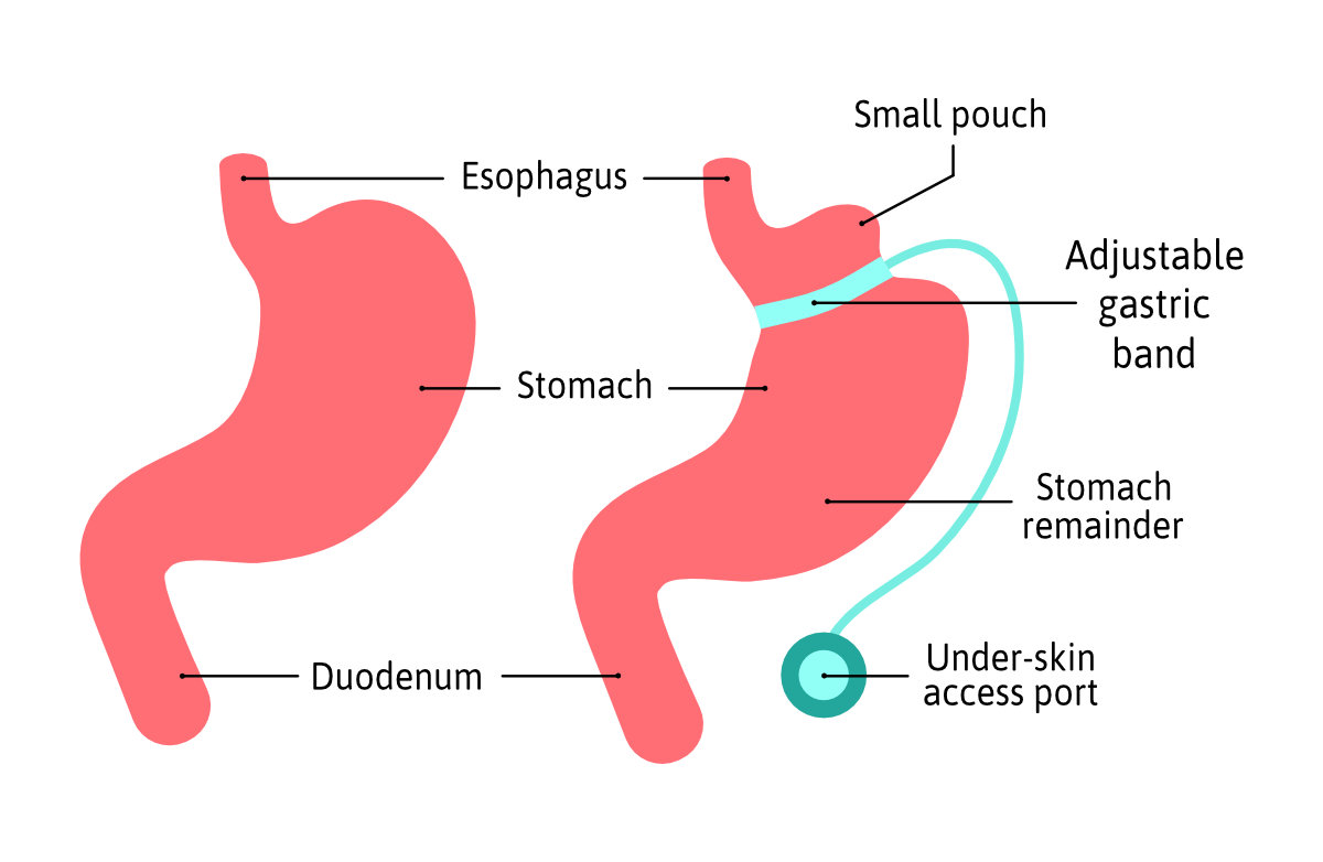 Downtown Los Angeles Lap-Band Surgery | Gastric Band Surgeon Near Me