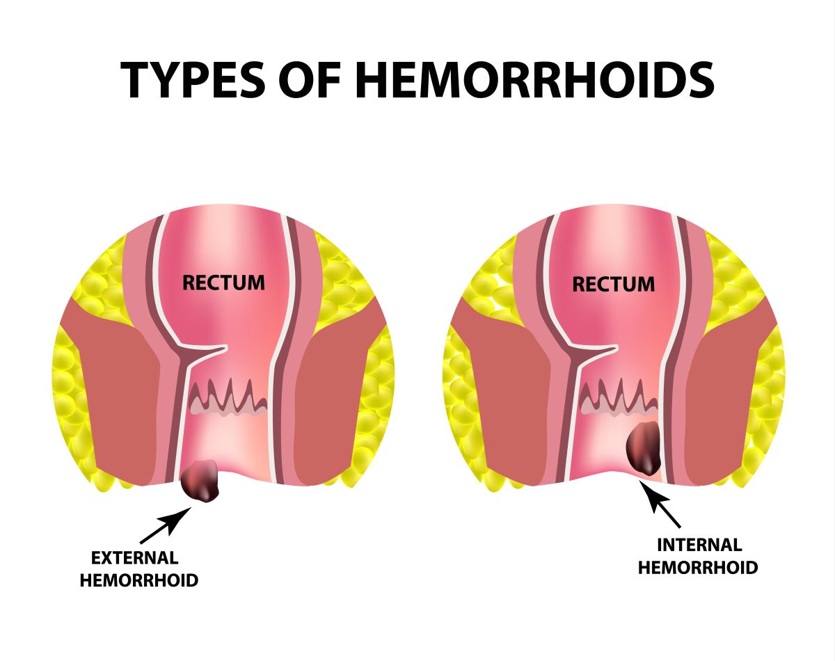 Two Types Of Hemorrhoids Are External And Internal. Rectum Struc