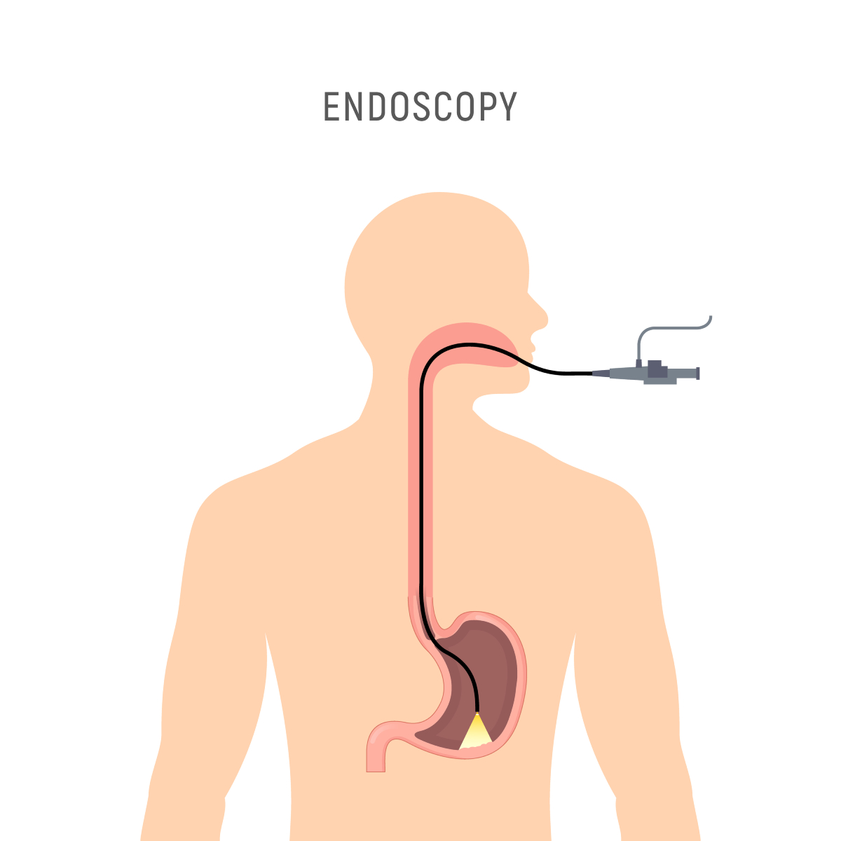 endoscopy stomach