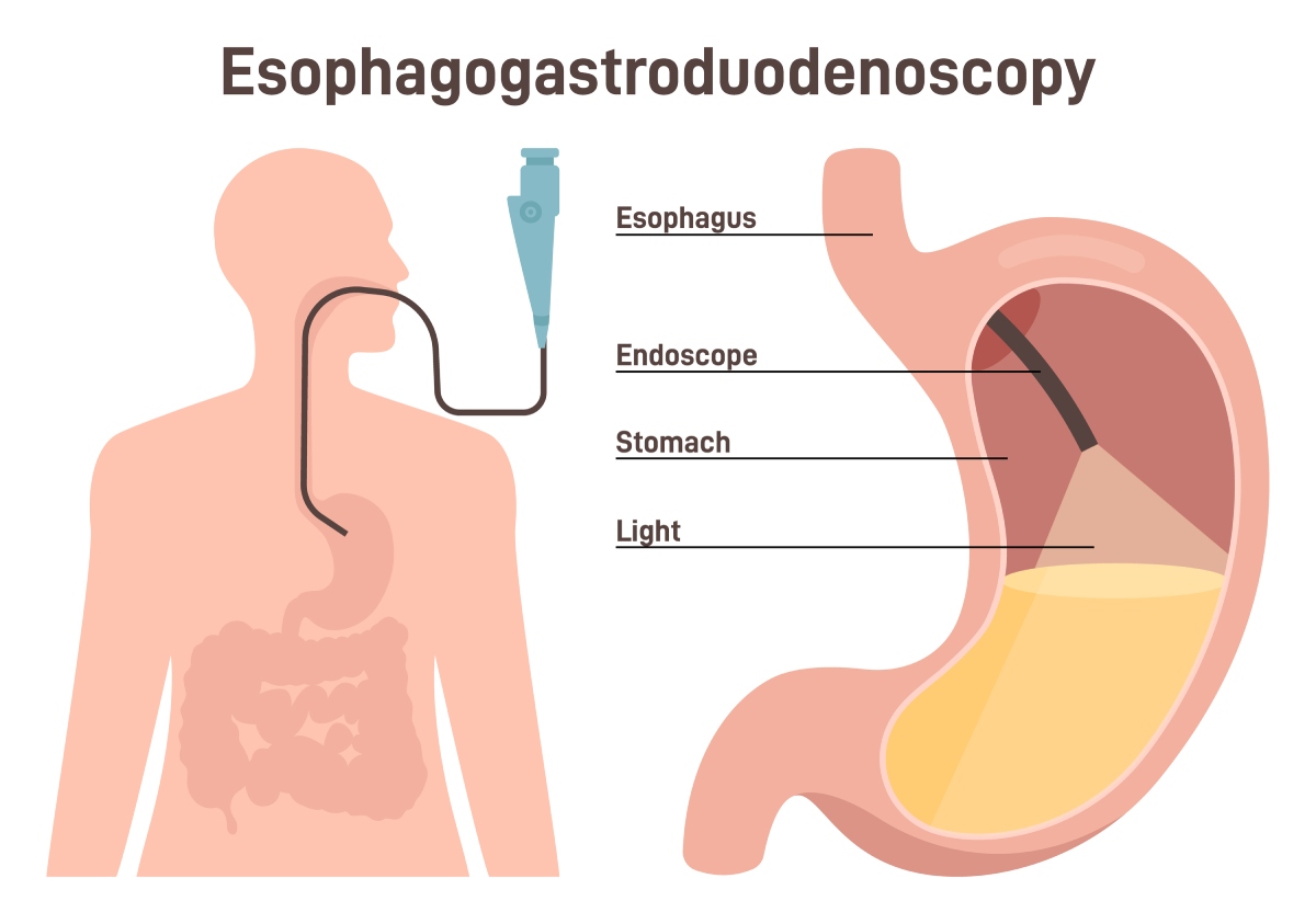 upper endoscopy | medical diagnostics of the esophageal, stomach