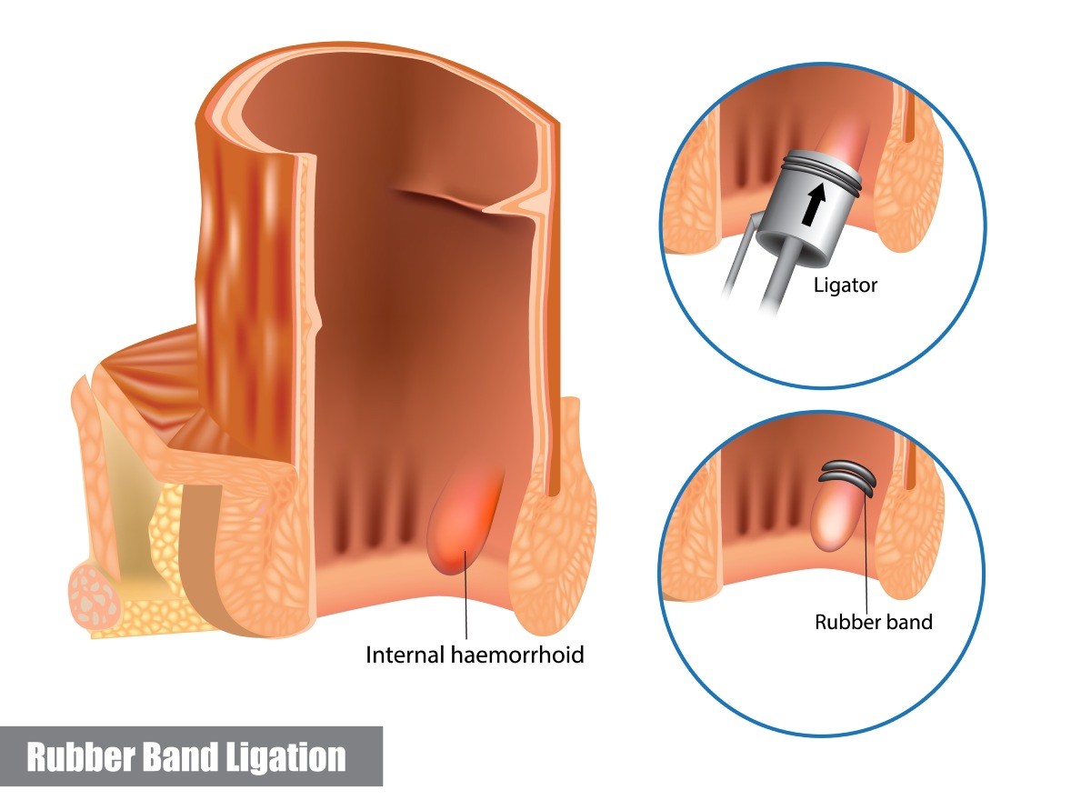 rubber band ligation of hemorrhoid