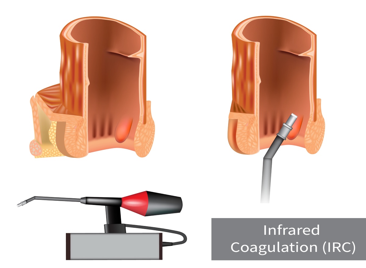 Infrared Coagulation for Hemorrhoid Treatment