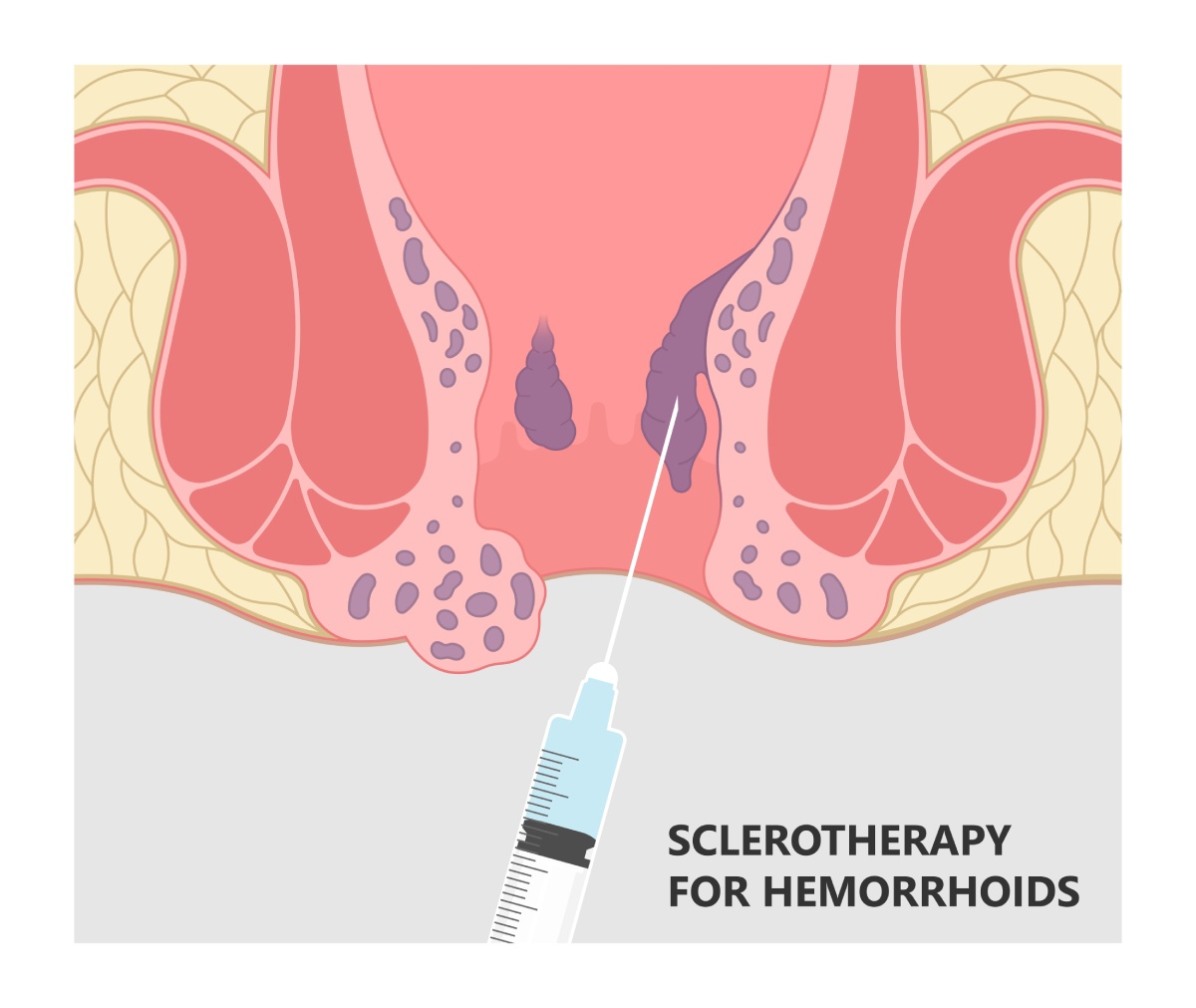 sclerotherapy for hemorrhoids