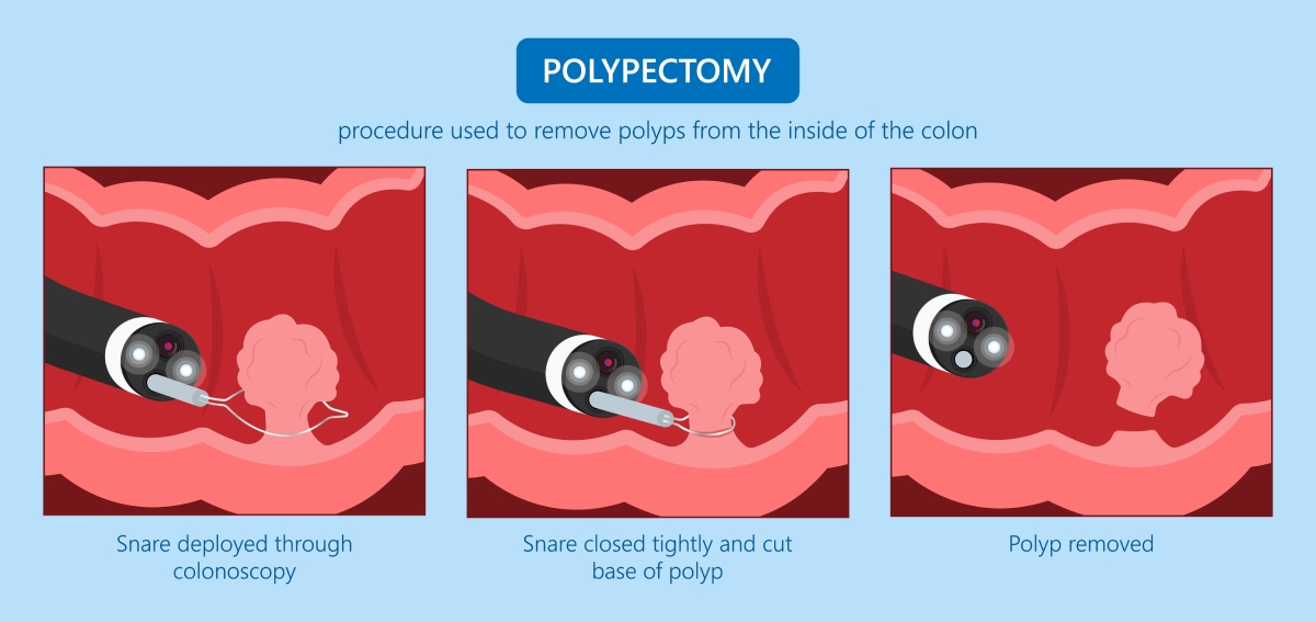 polypectomy procedure