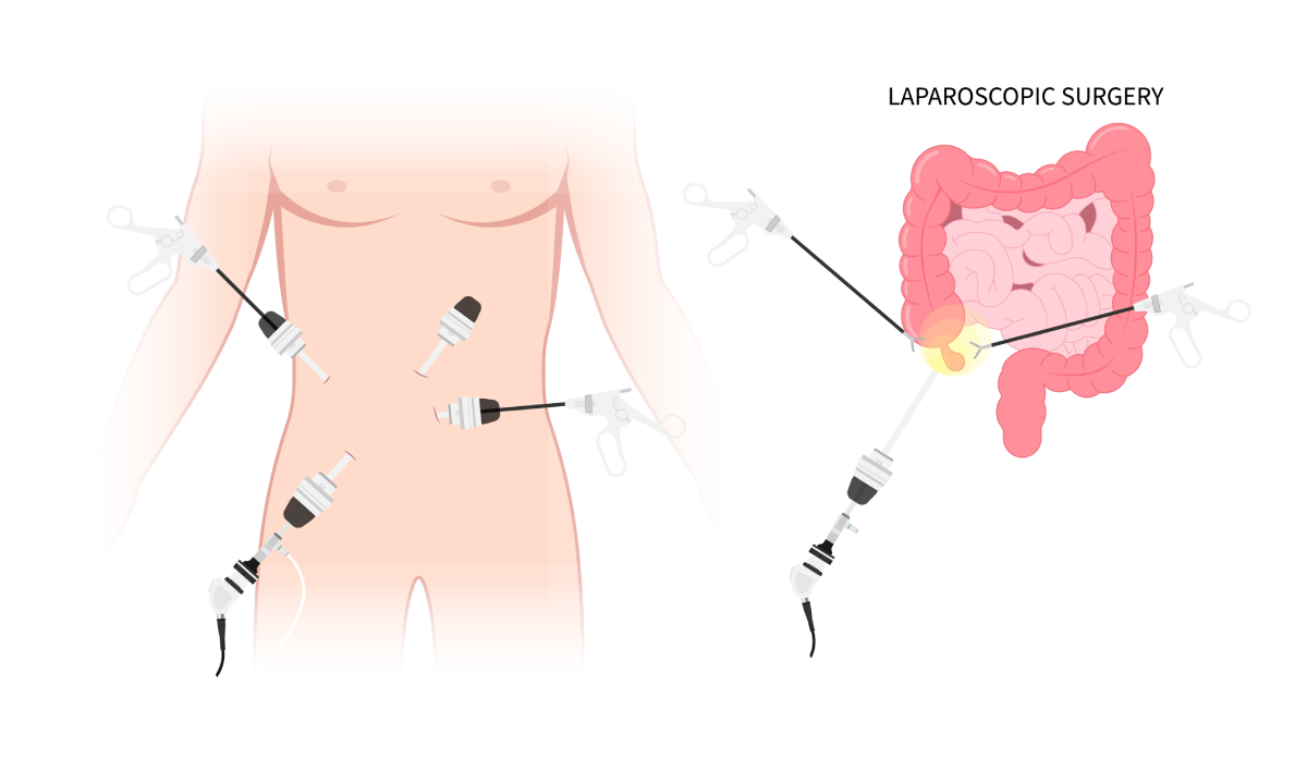 laparoscopic surgery