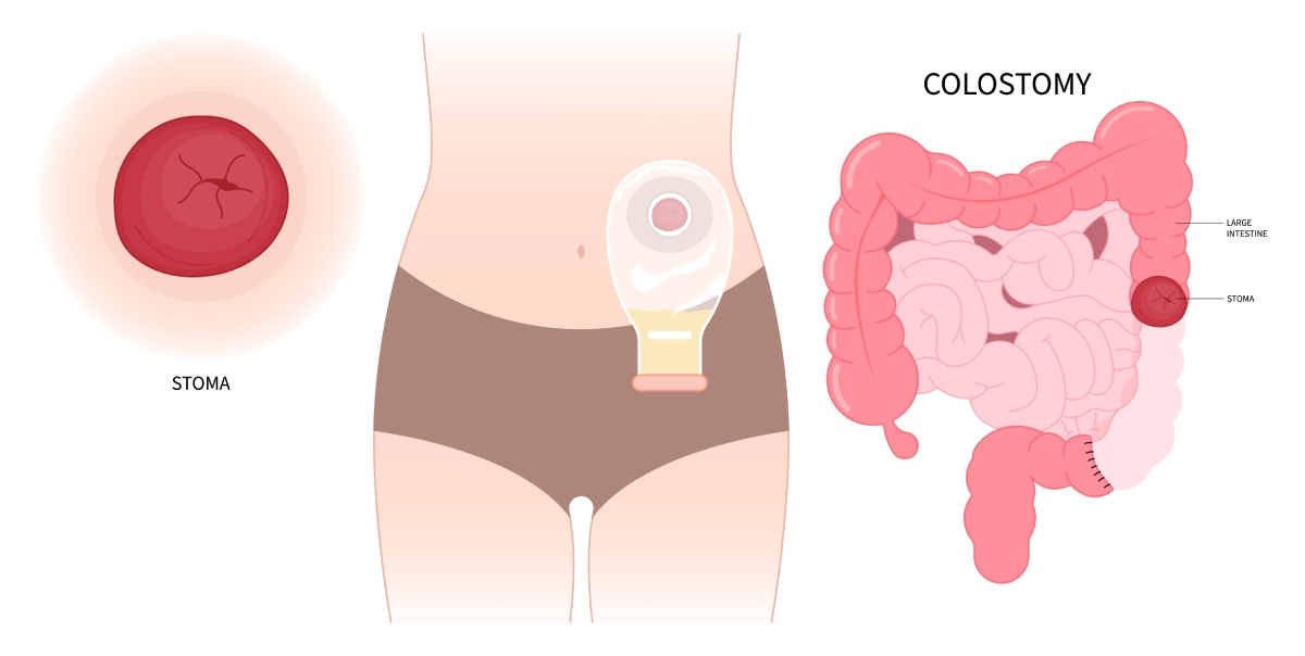 bowel resection with colostomy