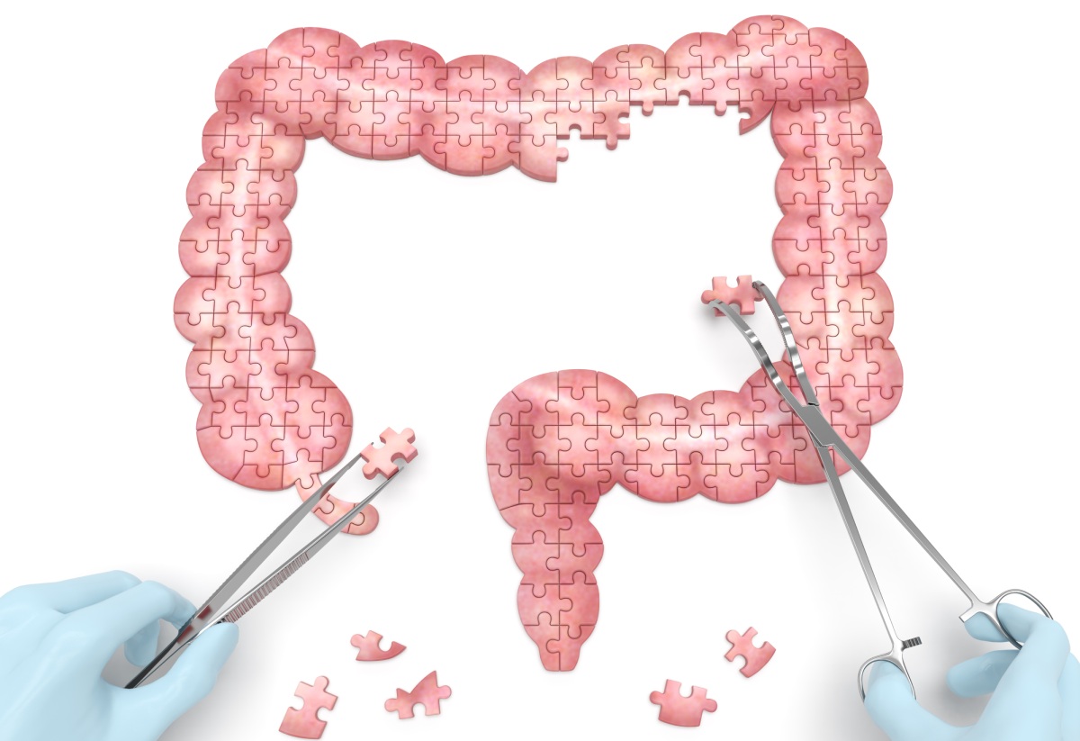 bowel resection