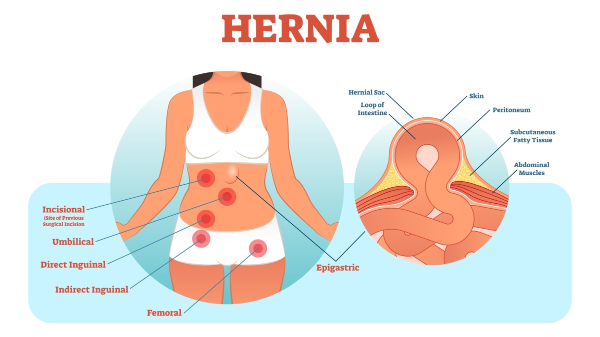 hernia types