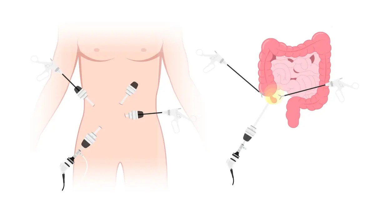laparoscopic surgery