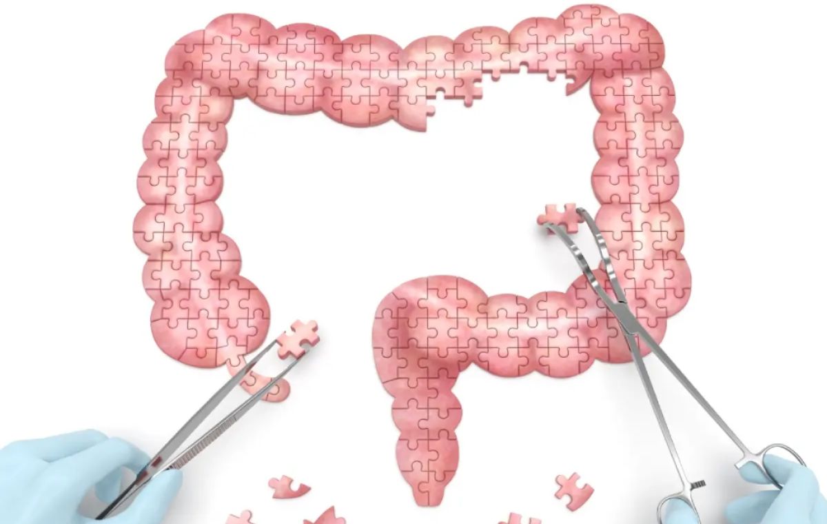 3D rendering of colon surgery concept: surgeon’s hands performing colorectal operation for colon polyps.